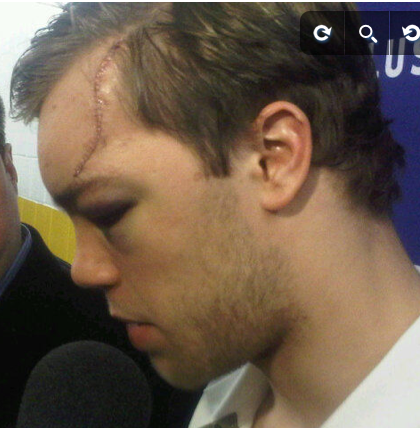 Taylor Hall With Stitches After Large Skate Cut on Forehead