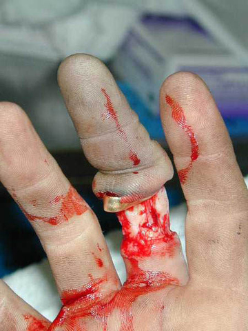Hockey Injury - Ring Finger Injury - Hockey Finger Injury